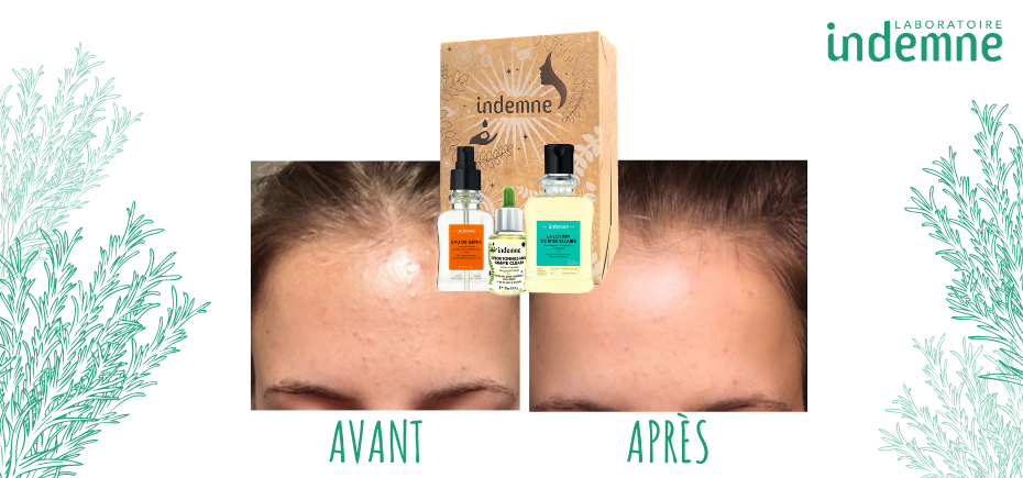 Résultats avant/après cure anti-imperfections